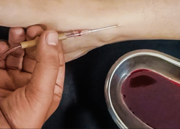 Shira Vedha – Ayurvedic Blood Cleansing Therapy
