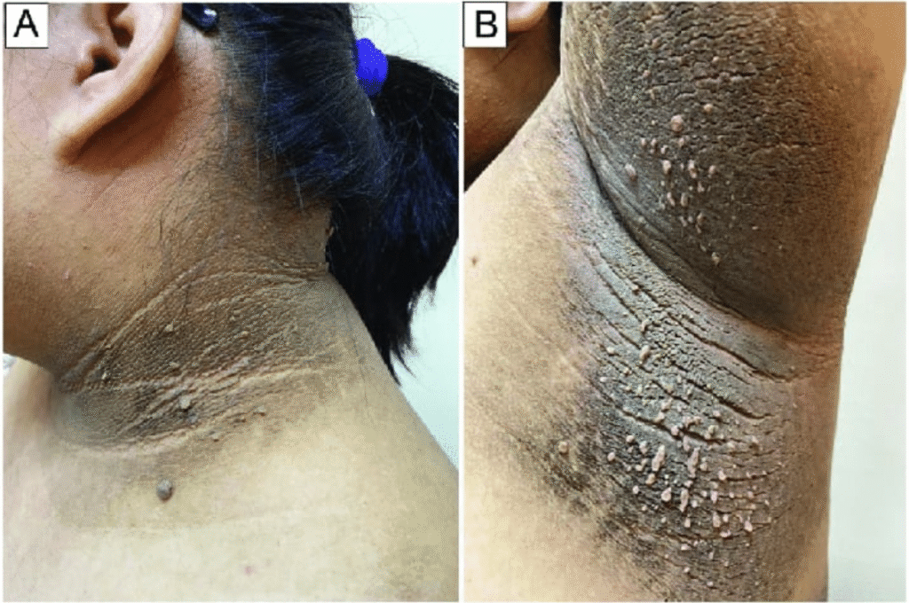 Metabolic changes -Darkening of skin (acanthosis nigricans) around the neck, armpits, or groin